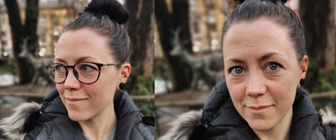 pasient hannah med og uten briller, før og etter laseroperasjon. foto.